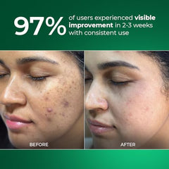 Aqueria Oil Control 3% Niacinamide French Face Serum for Oily & combination Skin with 2% BHA | Oil Free & Non Comedogenic Mattifying Anti Acne Serum | Fades Acne Marks & Reduces Dark Spots | Reduces Blackheads, Excess Oil & Bumpy Texture | Lightweight &…