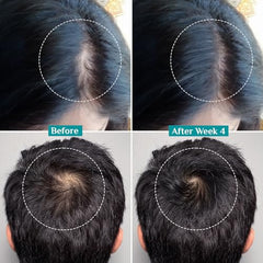 Pilgrim Advanced Hair Growth Serum with 3% Redensyl & 4% AnaGain -100ml | New Hair Growth in 28 Days, Korean Black Rice, Rosemary, Reduce Hair Fall, Hair Regrowth, Increase Hair Density, Thicker Hair