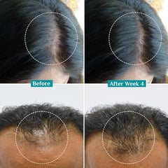 Pilgrim Advanced Hair Growth Serum with 3% Redensyl & 4% AnaGain -100ml | New Hair Growth in 28 Days, Korean Black Rice, Rosemary, Reduce Hair Fall, Hair Regrowth, Increase Hair Density, Thicker Hair