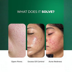 Aqueria Oil Control 3% Niacinamide French Face Serum for Oily & combination Skin with 2% BHA | Oil Free & Non Comedogenic Mattifying Anti Acne Serum | Fades Acne Marks & Reduces Dark Spots | Reduces Blackheads, Excess Oil & Bumpy Texture | Lightweight &…