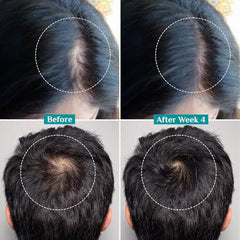 Pilgrim Advanced Hair Growth Serum with 3% Redensyl & 4% AnaGain -100ml | New Hair Growth in 28 Days, Korean Black Rice, Rosemary, Reduce Hair Fall, Hair Regrowth, Increase Hair Density, Thicker Hair
