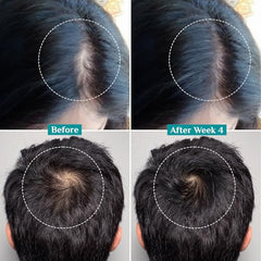 Pilgrim Advanced Hair Growth Serum with 3% Redensyl & 4% AnaGain -100ml | New Hair Growth in 28 Days, Korean Black Rice, Rosemary, Reduce Hair Fall, Hair Regrowth, Increase Hair Density, Thicker Hair